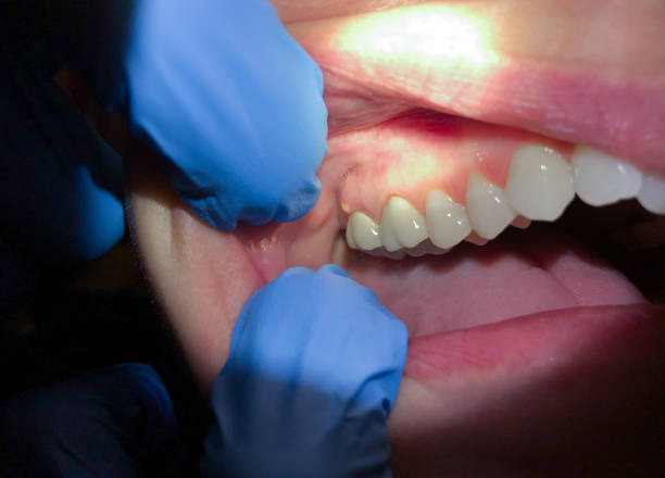 Best Urgent Tooth Repair  in Sellersburg, IN